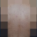 안영한의원 | 해율한의원 안양 등여드름, 모낭염 치료 사례 후기