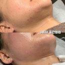 올뉴뷰티 마곡점 | 성동구 여드름 피부관리 올뉴뷰티 에스테틱 성수 내돈내산 후기