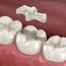 e편한치과기공소 | 치과의사가 알려주는 레진인레이와 세라믹인레이, 하이브리드인레이의 비교