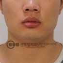 23년 치아교정 전문치과의 과개교합돌출입 치아교정 전후 후기