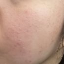 모델링클럽 | 홍대피부관리 <홍대뷰티클럽> 트러블피부 여드름 턱피지 관리 압출 통증