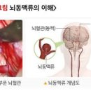 뇌혈관 뇌동맥류 및 원인검사 이미지