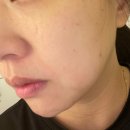 센텀365한의원 | [부산수영]모공피부관리,잡티제거피부과 다녀온 후기(MTS,레이저)