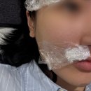 진해상패타월 | 강남역 성형외과에서 엔덤 알마하이브리드 조합으로 흉터치료 1회차 후기
