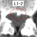 에녹 님의 요추디스크 L1-2의 MRI사진 판독입니다. 이미지