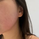 조은코스메틱 | [홍대 튠페이스 / 피부과 맛집 / 레이저 맛집] 하나도 안 아프고 예뻐진 후기