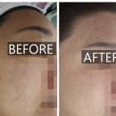 희메디칼 | [서울 강서]마곡피부관리여드름 희아로움 예민한 민감성 피부관리 후기