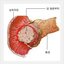 췌장암 초기증상 원인은? 이미지