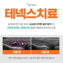 테넥스