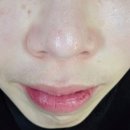 수니피부샵 | 대전 용문동 피부관리 설브 용문점 블랙헤드 관리 후기