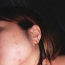 오늘의 기록 : Dermatop 크림으로 두드러기 나았어요 | 날씨 알레르기 피부과 후기