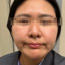 동양인 | 공덕역 피부과에서 마포 텐써마 600샷 후기 ( 동양인 맞춤 써마지 업그레이드 버전 )