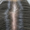 수원-1111 | [뷰티] SMP STUDIO 수원본점 두피관리 탈모예방 줄기세포 엑소좀 찐!!후기 1회차