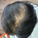 씨유 울산 신정아름점 | 울산 모류교정 뿌리펌 탈모커버까지(전후비교)