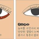 다래끼 초기 증상 전염, 맥립종 빨리 낫는 법 이미지