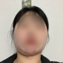 주바에스테틱 | [내돈내산/청주바본관리후기]이중턱 지방흡입 바본 없애기 프로젝트