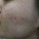 비비한의원 | 리유한의원 강남본점 여드름흉터 치료 가격 효과 후기 공유해요