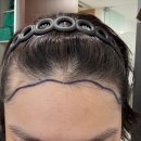 이후헤어 | 여성헤어라인교정 히든컷 모발이식 1800모 1년 후기(내돈내산 솔직후기)