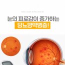 송도당뇨내과 당뇨 합병증, 당뇨망막병증이란?