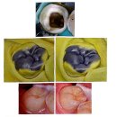 나래치과기공소 | 치과 임상 서적 정리 - Analogue dentistry 5장 (stamp 및 Hybrid stamp 기법)