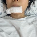 사진으로 보는 갑상선암 수술 후 회복과정😭솔직후기