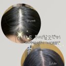 (주)라파메디 | 라파드 두피탈모센터 대구본점 12회차 전후변화 탈모성지