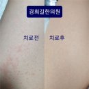 [두드러기/가려움] 경희길한의원을 다니면서 가려움 증세가 없어졌습니다. 이미지