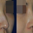 와인성형외과의원 | 코수술 후 음주와 흡연, 염증 발생 가능성은 얼마나 될까?