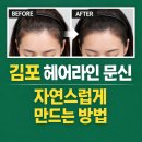 헤어라인 이미지