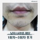U-3 | 남자 수염 레이저제모 후기 (U라인 + 목 추가 20회) 1~3차 내돈내산 솔직 후기