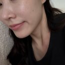 홍피부과의원 | 얀피부과 포텐자 펌핑팁 , 쥬베룩스킨부스터 3차 솔직 후기