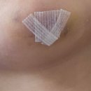 한땀성형외과의원 | 정자역 한땀성형외과 얼굴 상처 봉합 후기