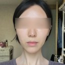 대전 피부과 올타이트 리프팅 후기 (시술 후 변화과정 세세하게!)