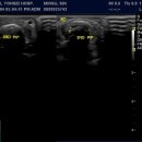 Sagittal band Partial Tear 이미지
