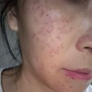 더블유스토어 유앤아이약국 | 압구정 기미 주근깨 루미레이저 루나의원 내돈내산 1주일 후기