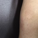 더본마취통증의학과의원 | 외상성 장액종 seroma 넘어지고 나서 생긴 혹 수원 더본마취통증의학과 의원