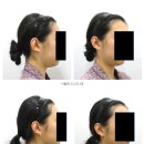 씨엘의원 | 이중턱지방흡입 부작용? 이 1가지 놓치면 100% 후회합니다<후기0>