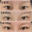 내일엔(N)성형외과의원 | 압구정에서 강남으로 확장 이전! 케이성형외과에서 3분 유착 + 캔디트임 수술 받은 솔직 후기