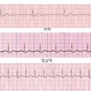 부정맥 원인 증상 빈맥 서맥 방법 관리방법 이미지