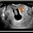 류내과의원 | [ 일산차 ] 7주 8주 / 증상 - 먹덧과 무기력증 / 젤리곰 / 난임과 졸업