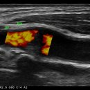 무증상 우측 외경동맥 기시부 협착, moderate stenosis. 이미지
