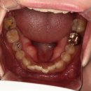 연세참예쁜치과교정과치과의원 | "연세참예쁜교정치과" 교정 시작