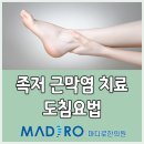 족저 근막염 증상 발뒤꿈치 통증 치료 도침요법 이미지