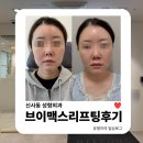 신사동-20 | 신사동 성형외과 | 브이맥스 리프팅 효과 내돈내산 리얼 후기 공개