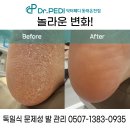 닥터페디(동래온천점) | (닥터페디 동래온천점) 부산 북구 덕천동 발각질 관리 궁금하시다면