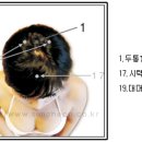 사혈부항 - 사혈부항(瀉血 附缸) :두통과 탈모 이미지