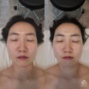 천안윤곽관리 비칠영에스테틱 얼굴비대칭관리 후기