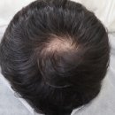 탈모야안녕 이미지