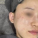 532 | 압구정피부과 잡티레이저 (532레이저) 후기 주근깨&amp;잡티 많은 피부의 피부과시술 추천