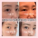 클레어성형외과의원 | 눈 밑 꺼짐 울트라콜200 2cc 시술 7일 전후 비교 붓기 관리 방법 부작용